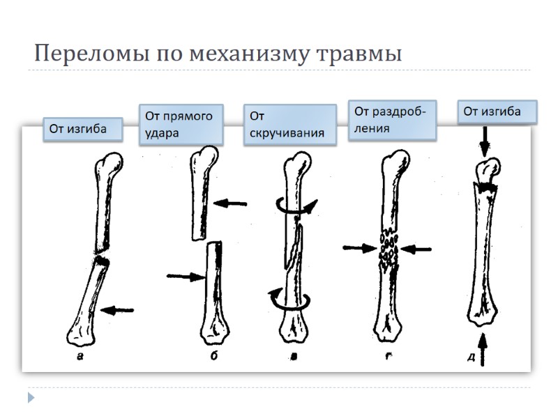Переломы по механизму травмы От изгиба От прямого удара От скручивания От раздроб-ления От